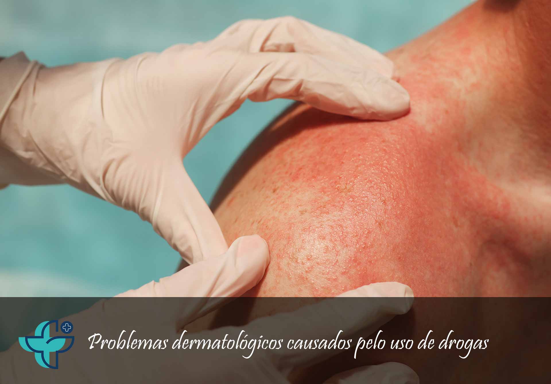 problemas dermatologicos causados pelo uso de drogas